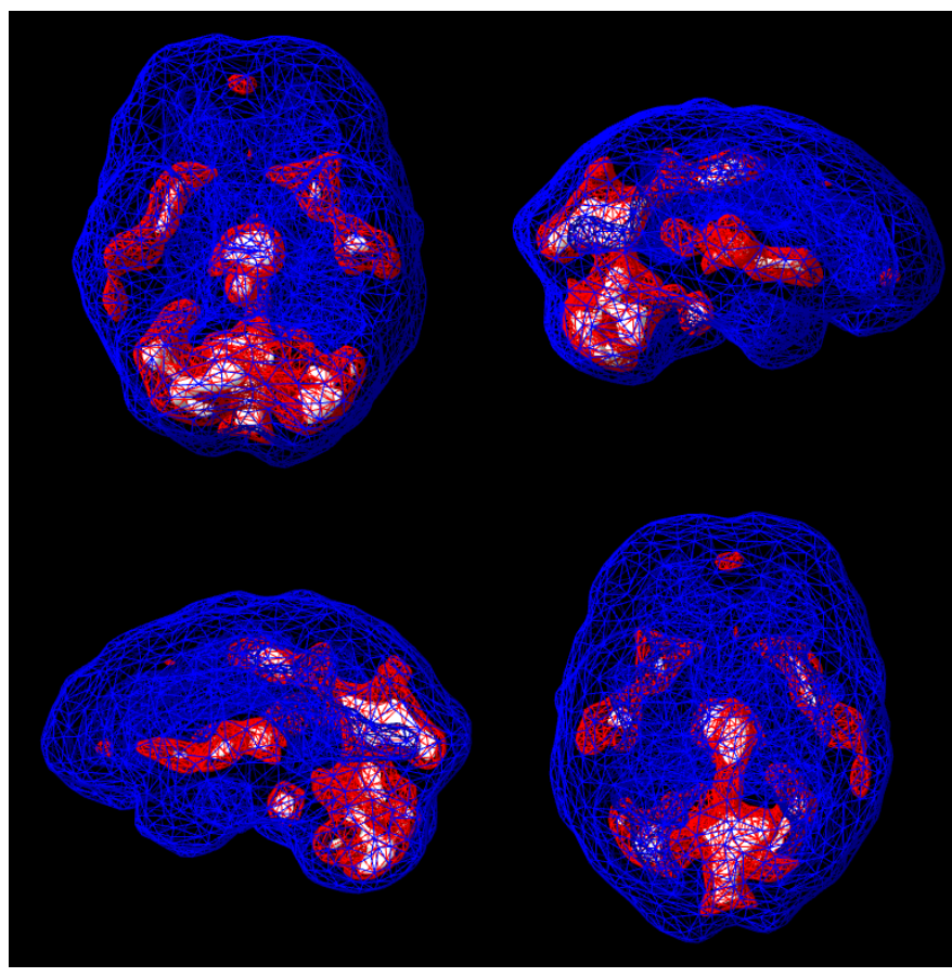 Blood-flow SPECT — 3D active overlay, blue wireframe with red hotspots